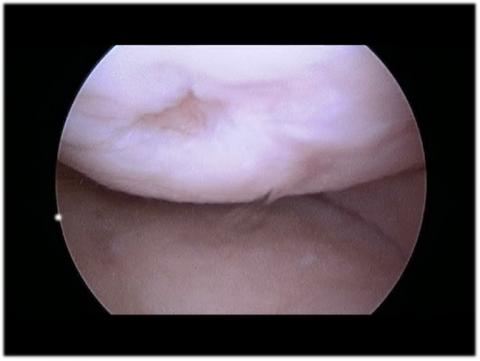 Treating Articular Cartilage Defects in the Knee